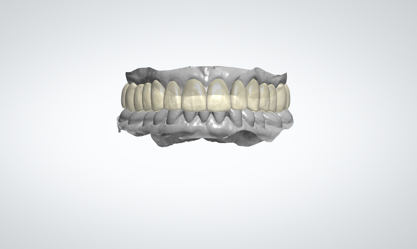 Digital Wax-Up Design