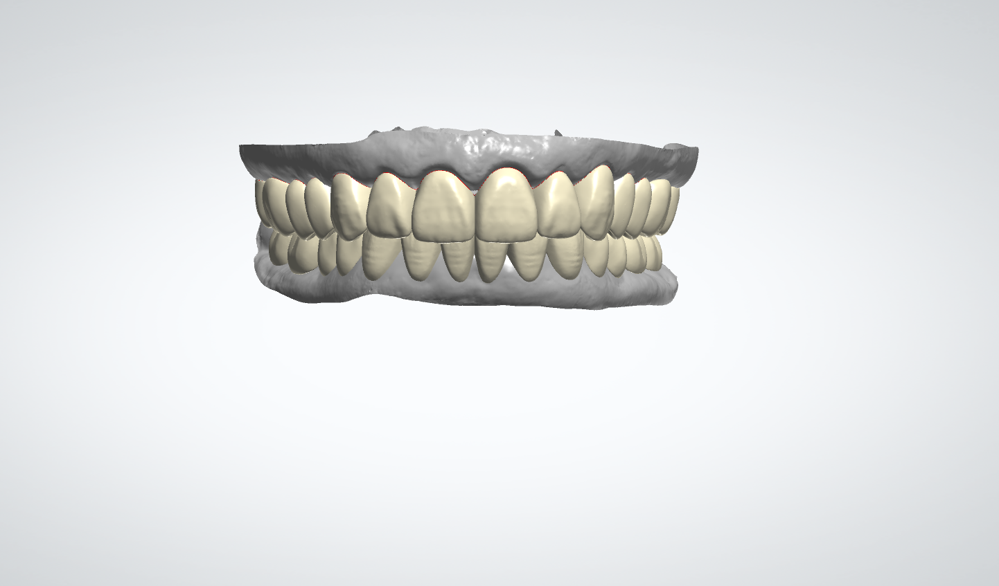 Temporary Restoration